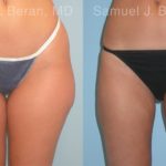 Liposuction Before and After Photos in Montvale, NJ, Patient 12893