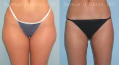 Liposuction Before and After Photos in Montvale, NJ, Patient 12893