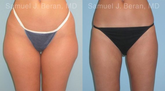 Liposuction Before and After Photos in Montvale, NJ, Patient 12893