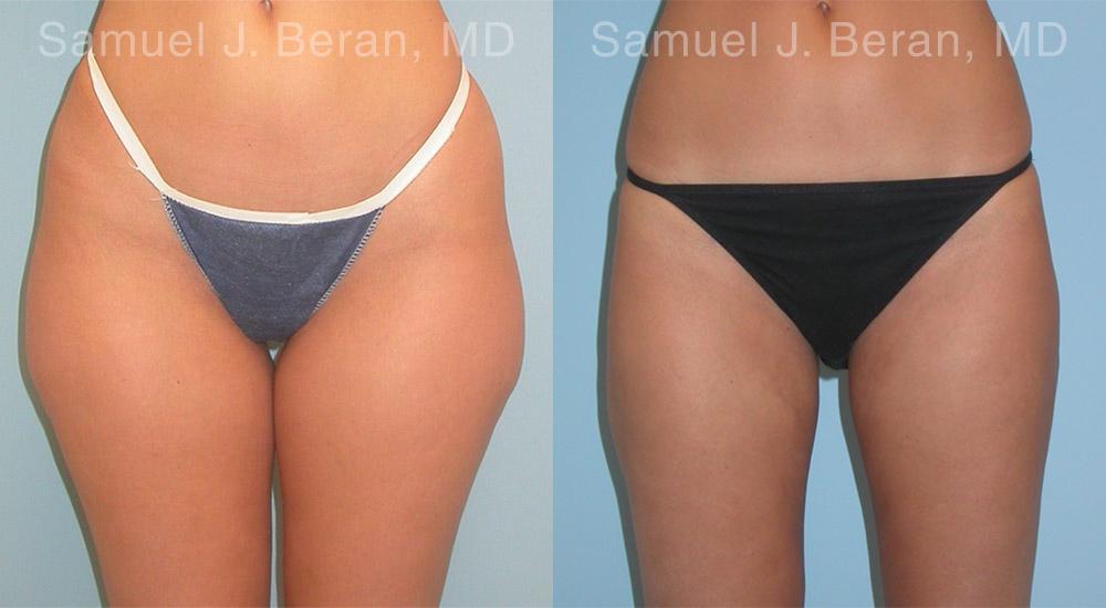 Liposuction Before and After Photos in Montvale, NJ, Patient 12893