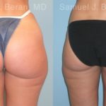 Liposuction Before and After Photos in Montvale, NJ, Patient 12893