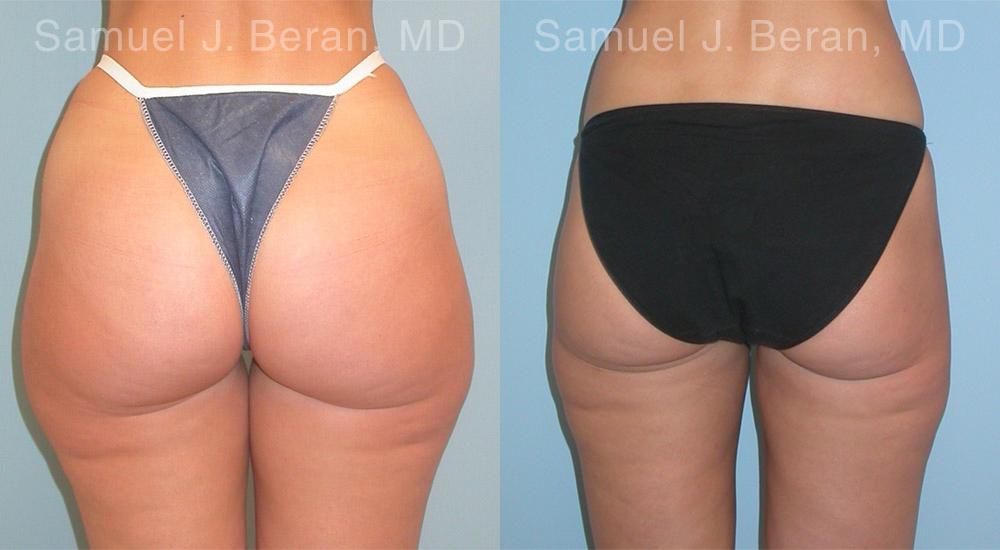 Liposuction Before and After Photos in Montvale, NJ, Patient 12893