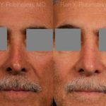 Non-Surgical Rhinoplasty Before and After Photos in Montvale, NJ, Patient 12901