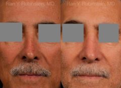 Non-Surgical Rhinoplasty Before and After Photos in Montvale, NJ, Patient 12901