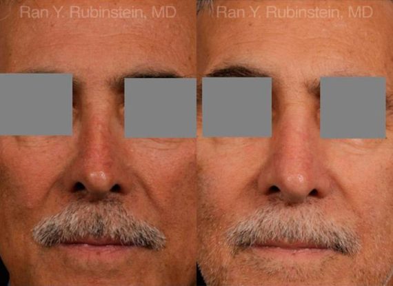 Non-Surgical Rhinoplasty Before and After Photos in Montvale, NJ, Patient 12901