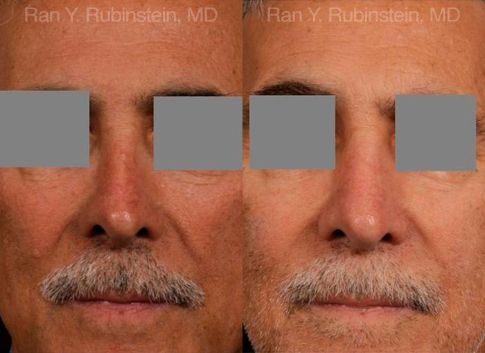 Non-Surgical Rhinoplasty Before and After Photos in Montvale, NJ, Patient 12901