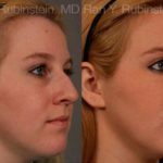 Non-Surgical Rhinoplasty Before and After Photos in Montvale, NJ, Patient 12904