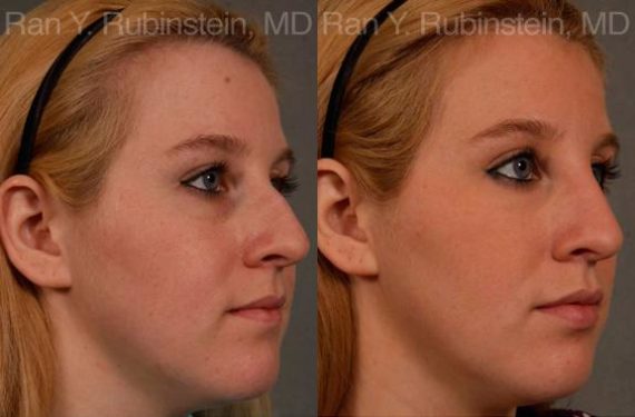 Non-Surgical Rhinoplasty Before and After Photos in Montvale, NJ, Patient 12904