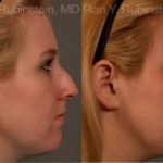Non-Surgical Rhinoplasty Before and After Photos in Montvale, NJ, Patient 12904