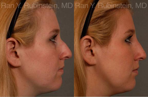 Non-Surgical Rhinoplasty Before and After Photos in Montvale, NJ, Patient 12904