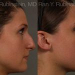 Non-Surgical Rhinoplasty Before and After Photos in Montvale, NJ, Patient 12909