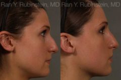 Non-Surgical Rhinoplasty Before and After Photos in Montvale, NJ, Patient 12909