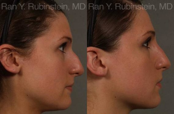 Non-Surgical Rhinoplasty Before and After Photos in Montvale, NJ, Patient 12909
