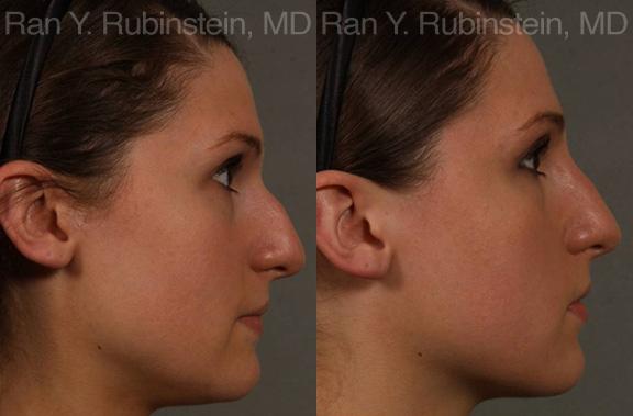 Non-Surgical Rhinoplasty Before and After Photos in Montvale, NJ, Patient 12909