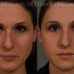 Non-Surgical Rhinoplasty Before and After Photos in Montvale, NJ, Patient 12909