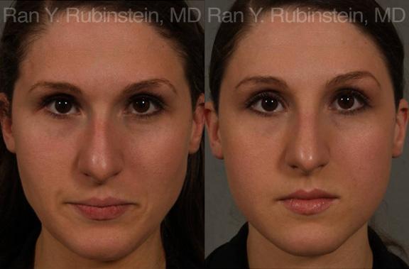 Non-Surgical Rhinoplasty Before and After Photos in Montvale, NJ, Patient 12909