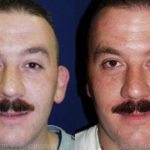Otoplasty Before and After Photos in Montvale, NJ, Patient 12947