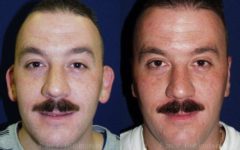 Otoplasty Before and After Photos in Montvale, NJ, Patient 12947