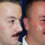 Otoplasty Before and After Photos in Montvale, NJ, Patient 12947