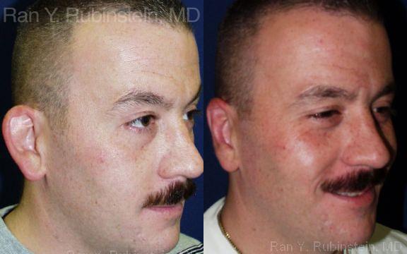 Otoplasty Before and After Photos in Montvale, NJ, Patient 12947