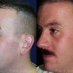 Otoplasty Before and After Photos in Montvale, NJ, Patient 12947