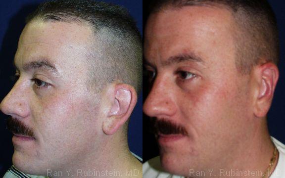 Otoplasty Before and After Photos in Montvale, NJ, Patient 12947