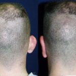 Otoplasty Before and After Photos in Montvale, NJ, Patient 12947