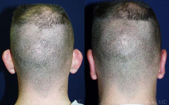Otoplasty Before and After Photos in Montvale, NJ, Patient 12947