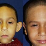Otoplasty Before and After Photos in Montvale, NJ, Patient 12961