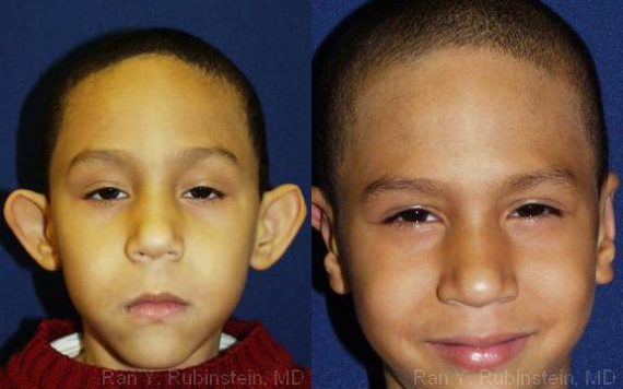 Otoplasty Before and After Photos in Montvale, NJ, Patient 12961