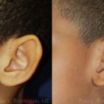 Otoplasty Before and After Photos in Montvale, NJ, Patient 12961