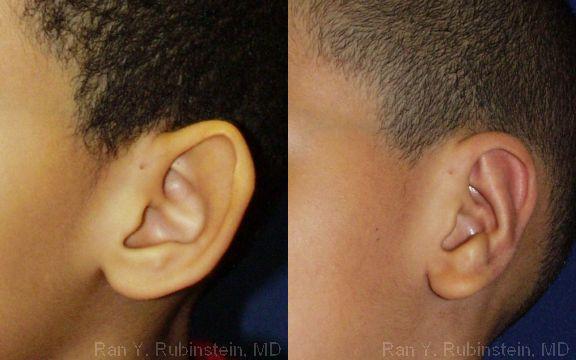 Otoplasty Before and After Photos in Montvale, NJ, Patient 12961