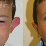 Otoplasty Before and After Photos in Montvale, NJ, Patient 12966