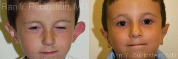 Otoplasty Before and After Photos in Montvale, NJ, Patient 12966