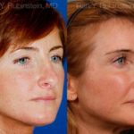 Revision Rhinoplasty Before and After Photos in Montvale, NJ, Patient 12982