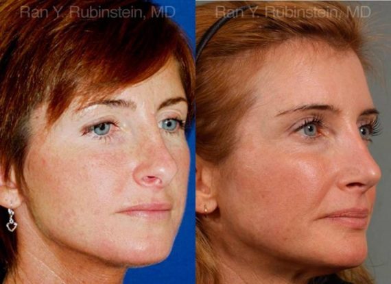 Revision Rhinoplasty Before and After Photos in Montvale, NJ, Patient 12982