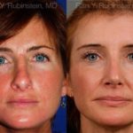 Revision Rhinoplasty Before and After Photos in Montvale, NJ, Patient 12982