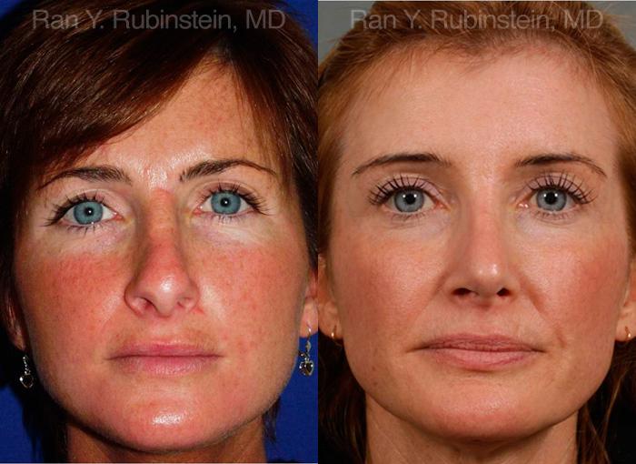 Revision Rhinoplasty Before and After Photos in Montvale, NJ, Patient 12982