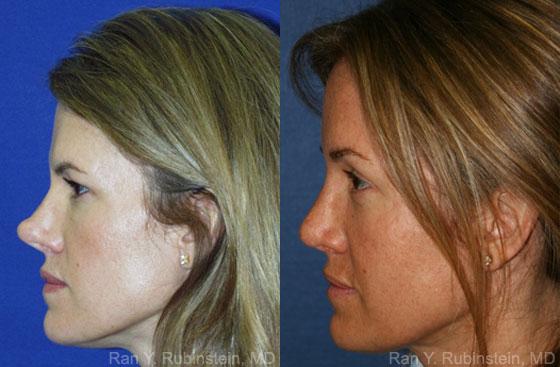 Revision Rhinoplasty Before and After Photos in Montvale, NJ, Patient 12987