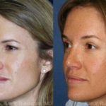 Revision Rhinoplasty Before and After Photos in Montvale, NJ, Patient 12987