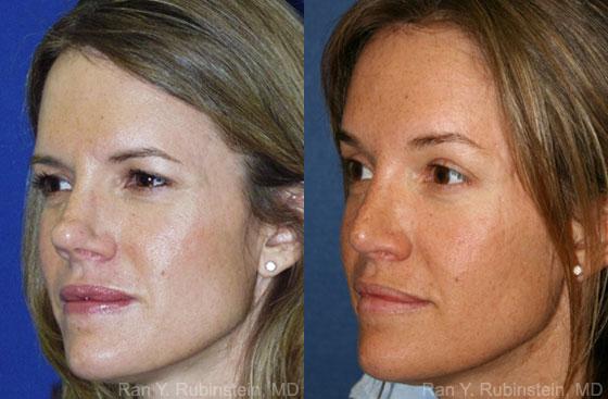 Revision Rhinoplasty Before and After Photos in Montvale, NJ, Patient 12987