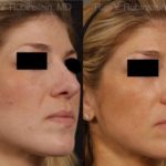 Revision Rhinoplasty Before and After Photos in Montvale, NJ, Patient 12994