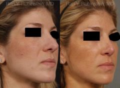 Revision Rhinoplasty Before and After Photos in Montvale, NJ, Patient 12994