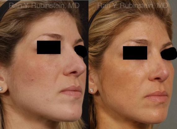 Revision Rhinoplasty Before and After Photos in Montvale, NJ, Patient 12994
