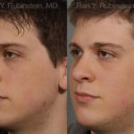 Revision Rhinoplasty Before and After Photos in Montvale, NJ, Patient 12997