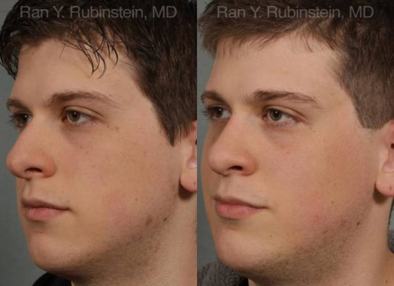 Revision Rhinoplasty Before and After Photos in Montvale, NJ, Patient 12997
