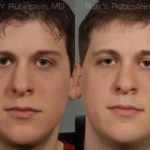Revision Rhinoplasty Before and After Photos in Montvale, NJ, Patient 12997