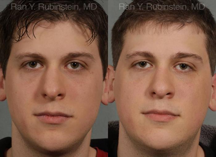 Revision Rhinoplasty Before and After Photos in Montvale, NJ, Patient 12997