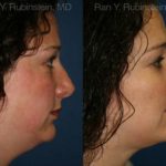 Revision Rhinoplasty Before and After Photos in Montvale, NJ, Patient 13002