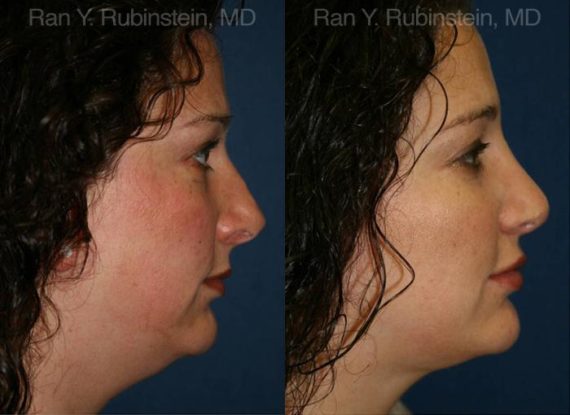 Revision Rhinoplasty Before and After Photos in Montvale, NJ, Patient 13002